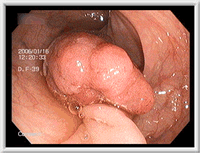 大腸ポリープ（早期ガン1）