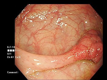 大腸ポリープの内視鏡的切除術